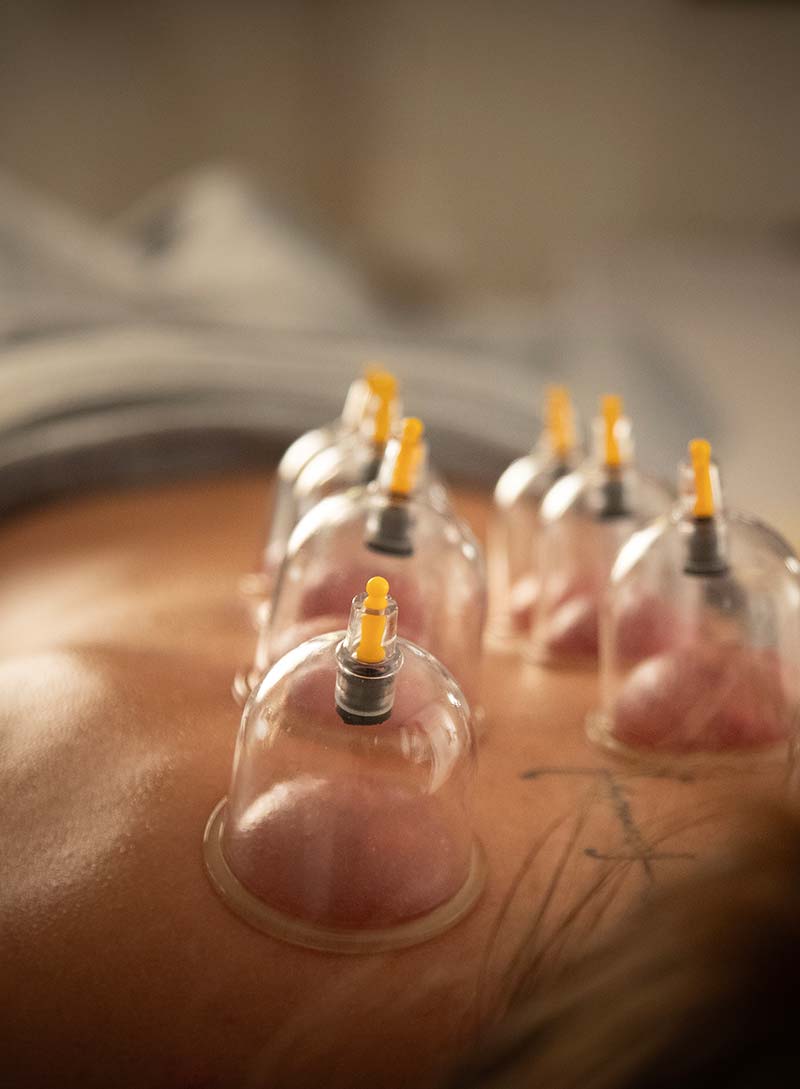 Alina Mack // Schröpfen